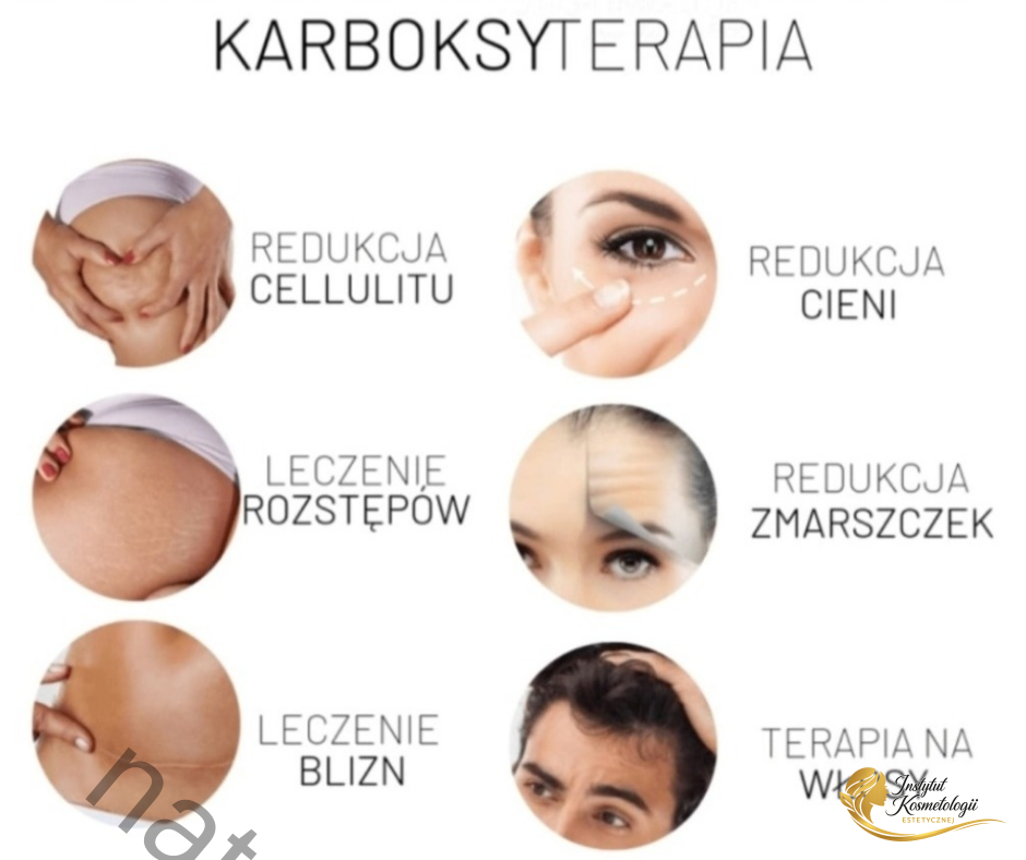 Karboksyterapia